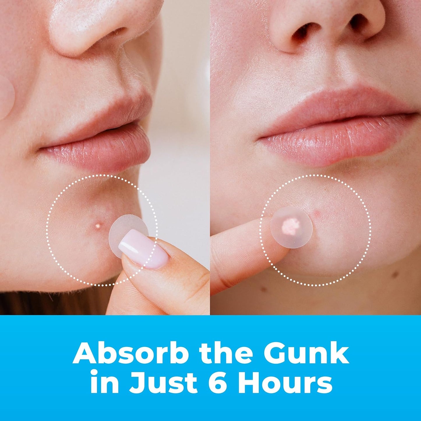 Pimple Patches for Face (240 Patches), Hydrocolloid Acne Patches with Tea Tree Oil, Pimple Stickers - Acne Pimple Patches for Face - Zit Patches