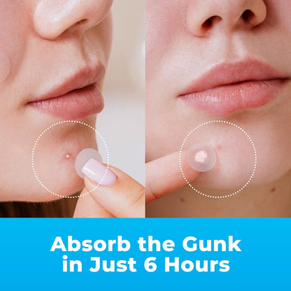 Pimple Patches for Face (240 Patches), Hydrocolloid Acne Patches with Tea Tree Oil, Pimple Stickers - Acne Pimple Patches for Face - Zit Patches